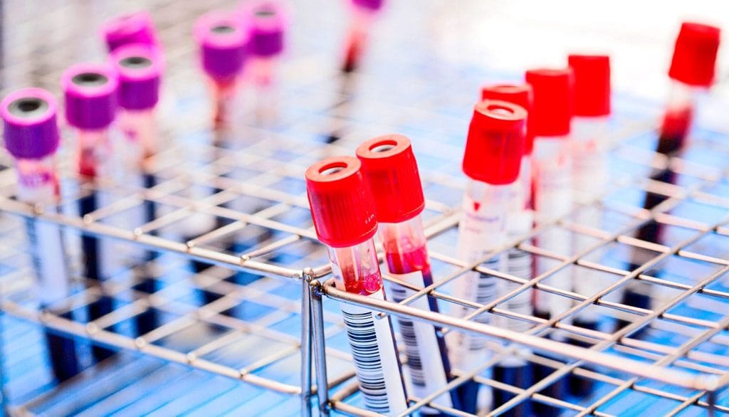 HIV-TB-blood-test-1600-1.jpg